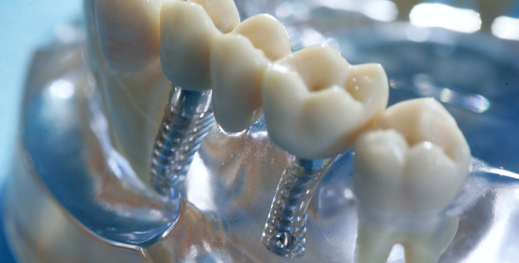 Implantate